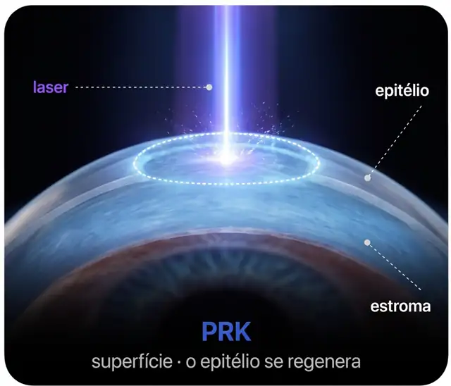 Ilustração do PRK: o laser trabalha na superfície da córnea depois que a película de cobertura é retirada